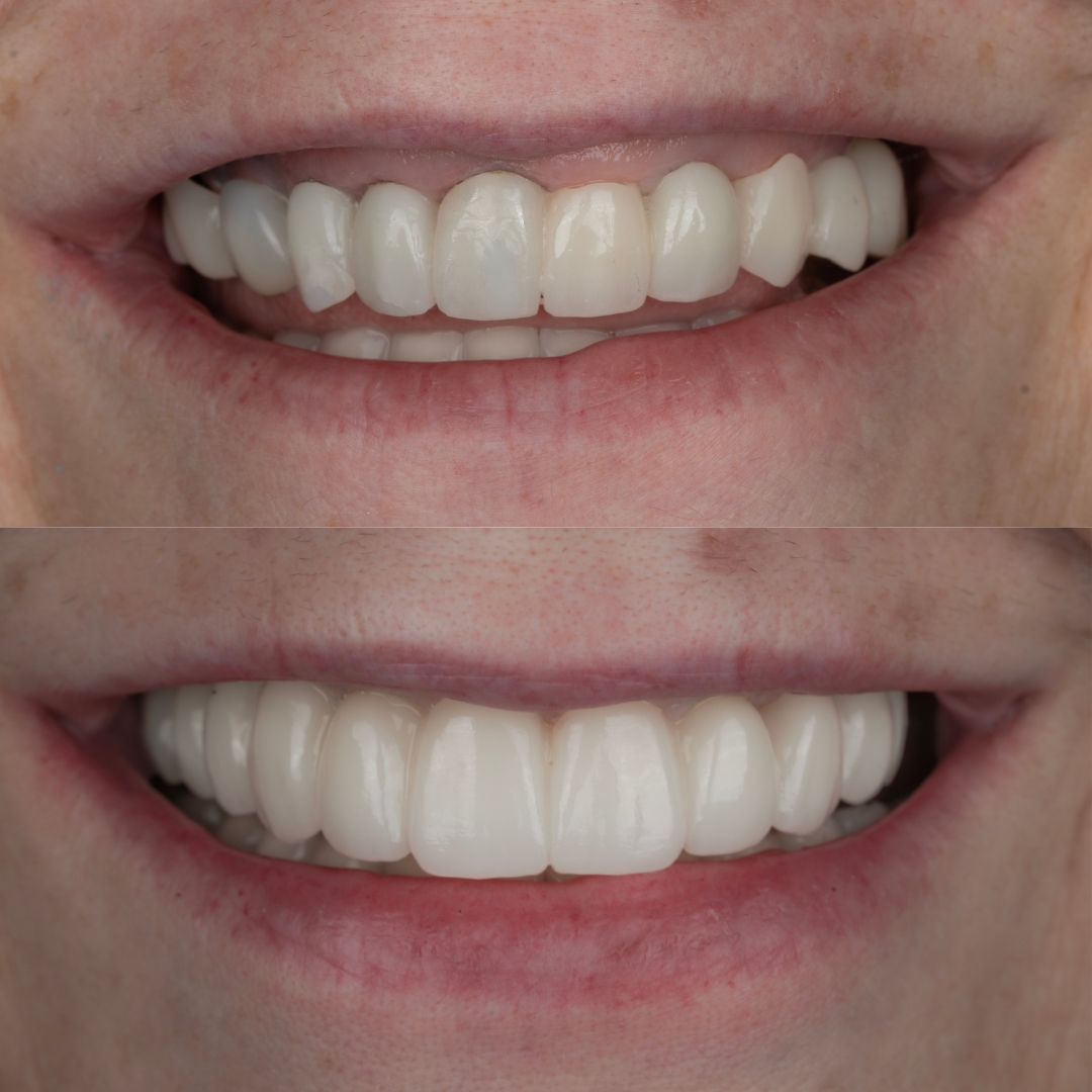 Before and after implant-supported dental bridge